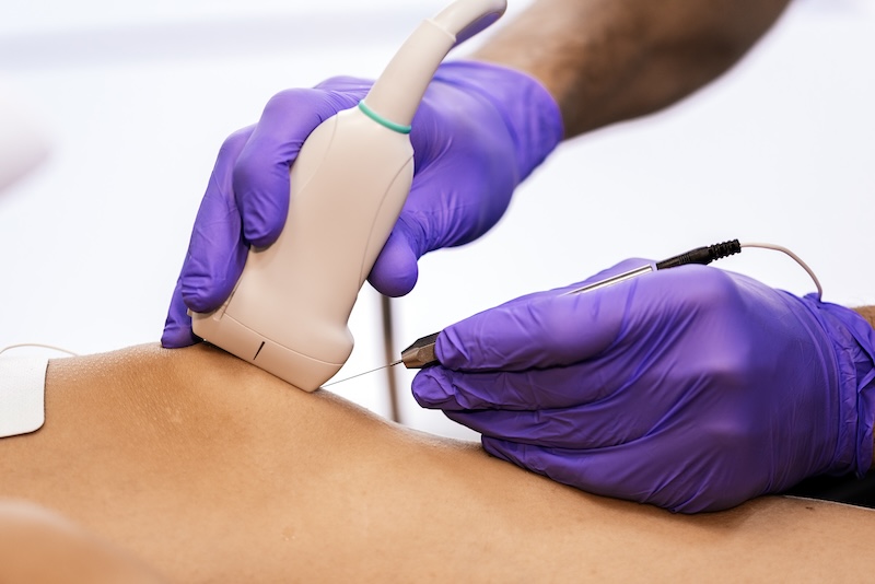 Electrolisis Percutánea Intratisular (EPI)